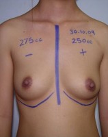 Breast Augmentation Process 03