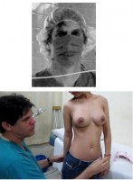 Breast Augmentation Process 05