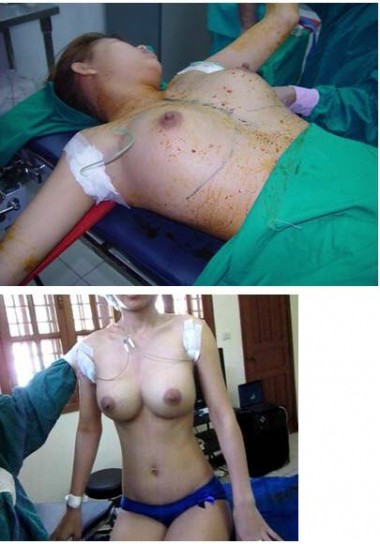 Breast Augmentation Process 08