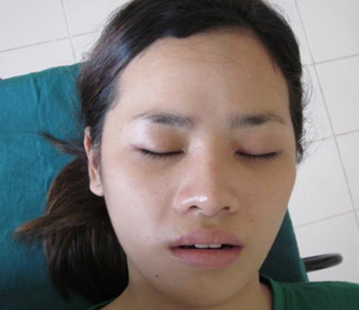 Dr Sheftall Plastic Surgery in Cambodia..Before & After