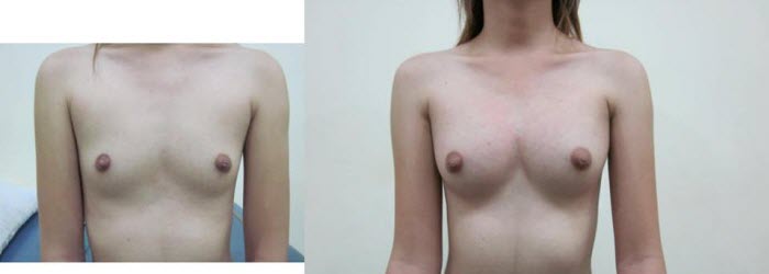 Worlds Best Breast Augmentation 113