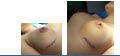 dr_reid_sheftall_cosmetic_plastic_surgery_breast_augmentation_implants_cambodia_065